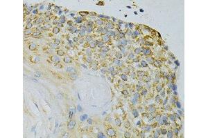 Immunohistochemistry of paraffin-embedded Human esophageal cancer using GPX4 Polyclonal Antibody at dilution of 1:200 (40x lens). (GPX4 Antikörper)