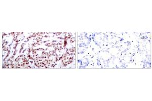 Immunohistochemical analysis of paraffin-embedded human breast carcinoma tissue using ATF-2 (phospho-Thr73 or 55) antibody (E011032). (ATF2 Antikörper  (pThr55, pThr73))