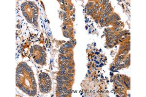 Immunohistochemistry of Human colon cancer using NCK1 Polyclonal Antibody at dilution of 1:30 (NCK1 Antikörper)