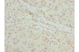 Immunohistochemistry of paraffin-embedded human liver cancer using ABIN7168087 at dilution of 1:100 (RIBC2 Antikörper  (AA 1-309))