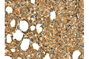 The image on the left is immunohistochemistry of paraffin-embedded Human thyroid cancer tissue using ABIN7130886(RLN1 Antibody) at dilution 1/20, on the right is treated with fusion protein. (Relaxin 1 Antikörper)