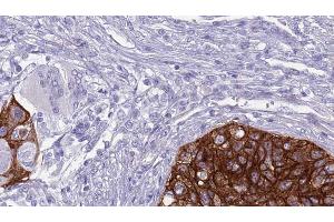 ABIN6268911 at 1/100 staining Human urothelial cancer tissue by IHC-P. (Claudin 11 Antikörper  (C-Term))