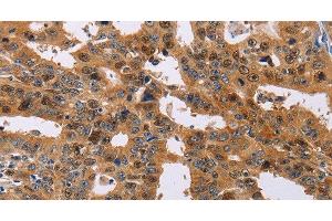 Immunohistochemistry of paraffin-embedded Human gasrtic cancer tissue using NIF3L1 Polyclonal Antibody at dilution 1:30 (NIF3L1 Antikörper)