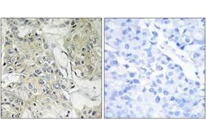 Immunohistochemistry analysis of paraffin-embedded human breast carcinoma tissue, using TM16J Antibody.