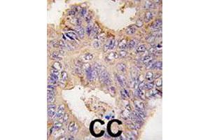 Formalin-fixed and paraffin-embedded human colon carcinoma tissue reacted with TRAF2 polyclonal antibody  , which was peroxidase-conjugated to the secondary antibody, followed by DAB staining. (TRAF2 Antikörper  (C-Term))