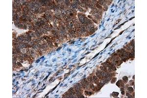 Immunohistochemical staining of paraffin-embedded Adenocarcinoma of breast tissue using anti-TPMT mouse monoclonal antibody. (TPMT Antikörper)