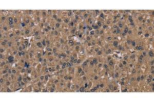 Immunohistochemistry of paraffin-embedded Human liver cancer tissue using FGF7 Polyclonal Antibody at dilution of 1:30 (FGF7 Antikörper)