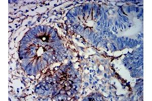 Immunohistochemical analysis of paraffin-embedded rectum cancer tissues using MUC16 mouse mAb with DAB staining. (MUC16 Antikörper  (AA 1-200))