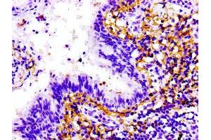 IHC image of ABIN7172220 diluted at 1:100 and staining in paraffin-embedded human lung cancer performed on a Leica BondTM system. (Titin Antikörper  (AA 5398-5604))