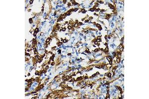 Immunohistochemistry of paraffin-embedded human lung cancer using SFTP Rabbit pAb (ABIN3017436, ABIN3017437, ABIN3017438 and ABIN6220091) at dilution of 1:50 (40x lens). (Surfactant Protein A1 Antikörper)