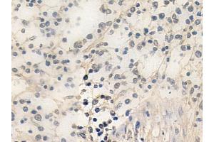 ABIN6259095 and ABIN6274375 at 1/100 staining human Hodgkin lymphoma by IHC-P. (NAB2 Antikörper  (C-Term))