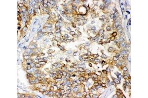 IHC-P: GCLC antibody testing of human lung cancer tissue (GCLC Antikörper  (AA 437-637))