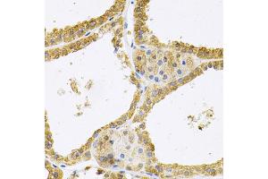 Immunohistochemistry of paraffin-embedded human thyroid cancer using FHL1 Antibody (ABIN1876648) at dilution of 1:100 (40x lens). (FHL1 Antikörper)