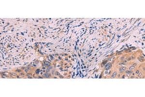 Immunohistochemistry of paraffin-embedded Human cervical cancer tissue using PPEF1 Polyclonal Antibody at dilution of 1:100(x200) (PPEF1 Antikörper)