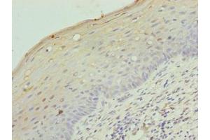 Immunohistochemistry of paraffin-embedded human cervical cancer using ABIN7158142 at dilution of 1:100 (LRRC18 Antikörper  (AA 1-261))