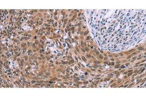 Immunohistochemistry of paraffin-embedded Human cervical cancer tissue using GLYR1 Polyclonal Antibody at dilution 1:30 (GLYR1 Antikörper)