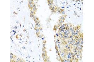 Immunohistochemistry of paraffin-embedded Human lung cancer using DARS2 Polyclonal Antibody at dilution of 1:100 (40x lens). (DARS2 Antikörper)