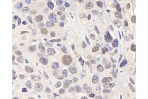 Immunohistochemistry analysis of paraffin-embedded Mouse breast cancer using CDC25A Polyclonal Antibody at dilution of 1:1000. (CDC25A Antikörper)
