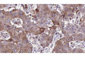 ABIN6276655 at 1/100 staining Human liver cancer tissue by IHC-P. (HFE Antikörper  (Internal Region))