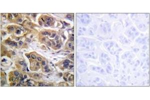 Immunohistochemistry analysis of paraffin-embedded human breast carcinoma tissue, using HER3 (Ab-1289) Antibody. (ERBB3 Antikörper  (AA 1256-1305))