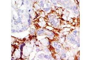 IHC analysis of FFPE human breast carcinoma tissue stained with the PAK3 antibody (PAK3 Antikörper  (AA 218-247))