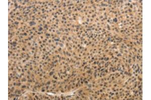 The image on the left is immunohistochemistry of paraffin-embedded Human liver cancer tissue using ABIN7189683(ADIPOR2 Antibody) at dilution 1/15, on the right is treated with synthetic peptide. (Adiponectin Receptor 2 Antikörper)
