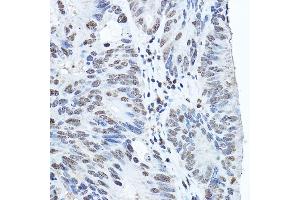Immunohistochemistry of paraffin-embedded human colon carcinoma using Twist Rabbit pAb (ABIN6133951, ABIN6149713, ABIN6149716 and ABIN6220170) at dilution of 1:200 (40x lens). (TWIST1 Antikörper  (AA 1-100))