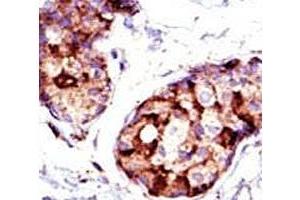 IHC analysis of FFPE human breast carcinoma tissue stained with the TSG101 antibody. (TSG101 Antikörper  (AA 1-30))