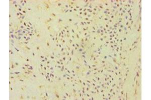 Immunohistochemistry of paraffin-embedded human breast cancer using ABIN7144871 at dilution of 1:100 (ATP5J Antikörper  (AA 1-108))