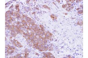 IHC-P Image MPP3 antibody detects MPP3 protein at cytosol on human breast cancer by immunohistochemical analysis. (MPP3 Antikörper  (Center))