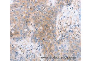 Immunohistochemistry of Human cervical cancer using LILRB2 Polyclonal Antibody at dilution of 1:30 (LILRB2 Antikörper)