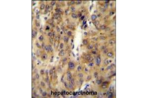 ACF Antibody immunohistochemistry analysis in formalin fixed and paraffin embedded human hepatocarcinoma followed by peroxidase conjugation of the secondary antibody and DAB staining. (A1CF Antikörper  (C-Term))