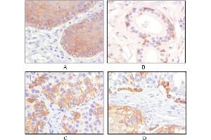 Immunohistochemical analysis of paraffin-embedded human esophagus epithelium (A), salivary gland basal cell (B), lung squamous cell carcinoma (C), endometrium admosquamous carcinoma (D), showing cytoplasmic and membrane localization using CK5 mouse mAb with DAB staining. (Cytokeratin 5 Antikörper)