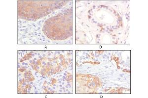 Immunohistochemical analysis of paraffin-embedded human esophagus epithelium (A), salivary gland basal cell (B), lung squamous cell carcinoma (C), endometrium admosquamous carcinoma (D), showing cytoplasmic and membrane localization using CK5 mouse mAb with DAB staining.