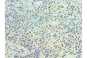 Immunohistochemistry of paraffin-embedded human breast cancer using ABIN7172113 at dilution of 1:100 (TK1 Antikörper  (AA 1-234))