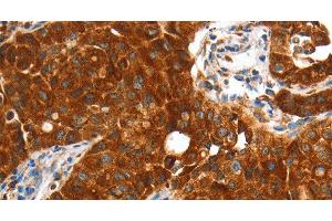 Immunohistochemistry of paraffin-embedded Human lung cancer using VWA5A Polyclonal Antibody at dilution of 1:60 (VWA5A Antikörper)
