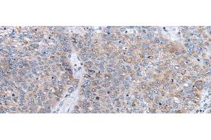 Immunohistochemistry of paraffin-embedded Human liver cancer tissue using ENPP2 Polyclonal Antibody at dilution of 1:50(x200) (ENPP2 Antikörper)