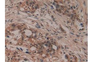 DAB staining on IHC-P; Samples: Human Pancreatic cancer Tissue (LIFR Antikörper  (AA 45-184))