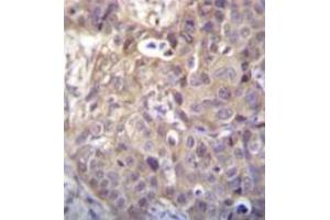 Immunohistochemistry analysis in formalin fixed and paraffin embedded human breast carcinoma recated with HIPK1 Antibody (C-term) followed by peroxidase conjugation of the secondary antibody and DAB staining.
