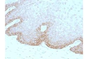 IHC testing of human cervical carcinoma with FAT2 antibody (clone 8C5).