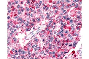 Anti-BAI2 antibody IHC of human Lung, Non-Small Cell Carcinoma. (BAI2 Antikörper  (N-Term))