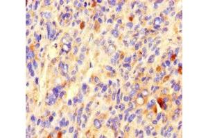 Immunohistochemistry of paraffin-embedded human melanoma using ABIN7148160 at dilution of 1:100 (CCDC84 Antikörper  (AA 1-200))