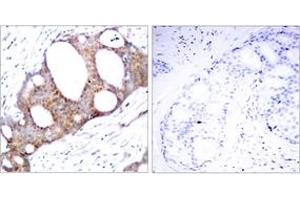 Immunohistochemistry analysis of paraffin-embedded human breast carcinoma, using GSK3 alpha (Phospho-Ser21) Antibody. (GSK3 alpha Antikörper  (AA 10-59))