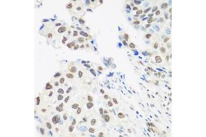 Immunohistochemistry of paraffin-embedded human prostate cancer using DDX39B antibody. (DDX39B Antikörper)