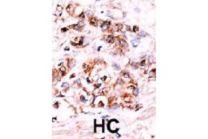 Formalin-fixed and paraffin-embedded human hepatocellular carcinoma tissue reacted with DUSP15 polyclonal antibody  , which was peroxidase-conjugated to the secondary antibody, followed by AEC staining. (DUSP15 Antikörper  (N-Term))
