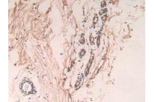 IHC-P analysis of Human Breast Cancer Tissue, with DAB staining. (Caspase 7 Antikörper  (AA 24-198))