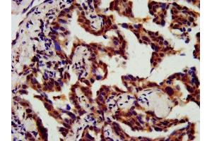 IHC image of ABIN7147529 diluted at 1:800 and staining in paraffin-embedded human lung cancer performed on a Leica BondTM system. (CHMP5 Antikörper  (AA 1-219))