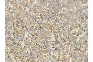 ZBTB7C Mouse Monoclonal Antibody at 1/100 staining human colorectal cancer by IHC-P. (ZBTB7C Antikörper)