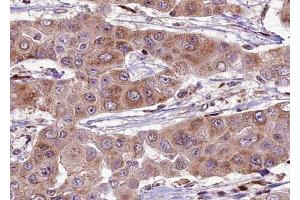 ABIN6274061 at 1/100 staining human liver carcinoma tissue sections by IHC-P. (Dynamin 1-Like Antikörper  (pSer637))