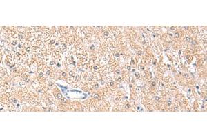 Immunohistochemistry of paraffin-embedded Human liver cancer tissue using MLKL Polyclonal Antibody at dilution of 1:85(x200) (MLKL Antikörper)